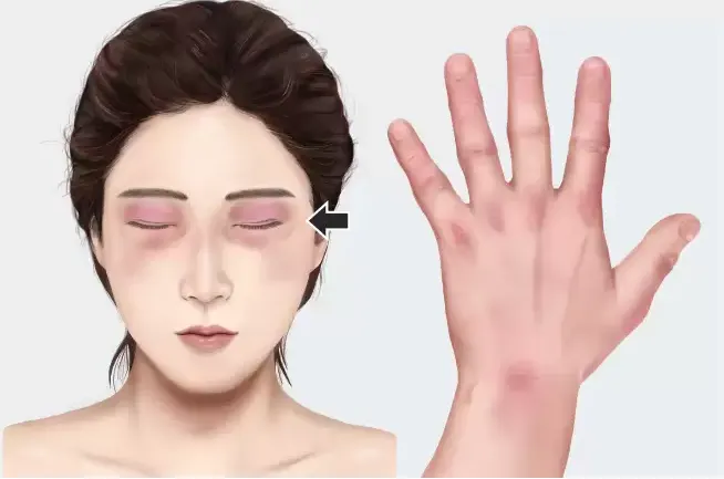 피부근염 이해를 돕기 위한 이미지